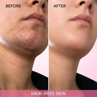 Hair Removal Trilogy Pack